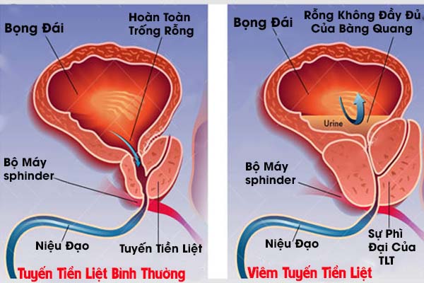 Triệu chứng bệnh viêm tiền liệt tuyến là gì? 1 Biểu hiện bệnh viêm tuyến tiền liệt